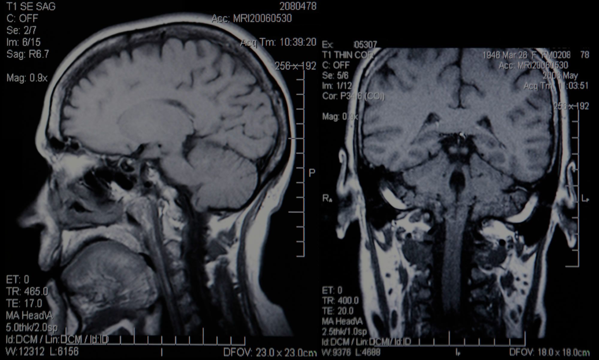 Head Injuries After a Car Accident